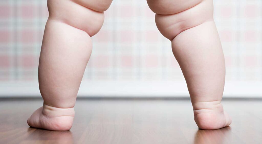 Obesity In Children And Its Risk To Their Health